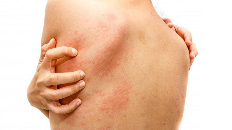 Cách nhận biết qua nốt phát ban trên da